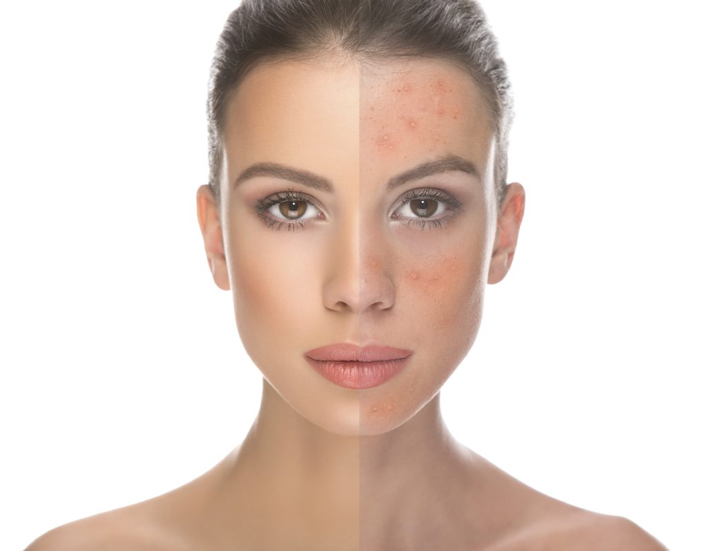 Saiba tudo sobre a acne
