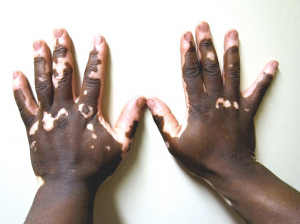Mãos com vitiligo | Vitiligo tem cura?